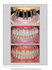 Research paper thumbnail of The CAD/CAM Compound Prosthesis: Digital Workflow for Fabricating Cement-Retained Zirconia Prosthesis Over Screw-Retained Milled Titanium Bars