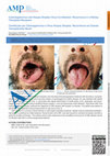 Research paper thumbnail of Cytomegalovirus and Herpes Simplex Virus Co-Infection: Recurrence in a Kidney Transplant Recipient