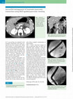 Research paper thumbnail of Successful management of traumatic pancreatic transection using ERCP-guided pancreatic stenting