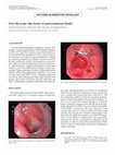 Research paper thumbnail of Over-the-scope clip closure of gastrocutaneous fistula