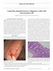 Research paper thumbnail of Carpet-Like Polypoid Lesion in Collagenous Colitis with Mucosal Giant Cells