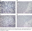 Research paper thumbnail of Supplementary Figure 1 from Next Generation Sequencing of Prostate Cancer from a Patient Identifies a Deficiency of Methylthioadenosine Phosphorylase, an Exploitable Tumor Target