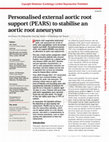 Research paper thumbnail of Personalised external aortic root support (PEARS) to stabilise an aortic root aneurysm