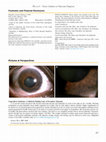 Research paper thumbnail of Cogan Reese Syndrome, a Unilateral Puzzling Cause of Secondary Glaucoma