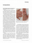 Research paper thumbnail of Unilateral idiopathic acquired dermal melanocytosis on a palm: An extremely rare entity in a young woman