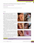 Research paper thumbnail of Hematoma del lóbulo de la oreja por oxímetro