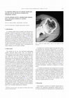 Research paper thumbnail of La calcitonine utilisée pour un syndrome épaule-main peut-elle avoir un rôle dans la révélation d'un méningiome cérébral ?