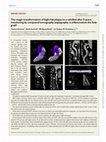 Research paper thumbnail of The magic transformation of high-risk plaque to a calcified after 5 years: monitoring by computed tomography angiography: is inflammation the holy grail?