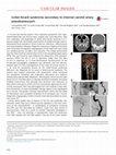 Research paper thumbnail of Collet-Sicard syndrome secondary to internal carotid artery pseudoaneurysm