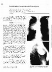 Research paper thumbnail of Sackförmiges Aneurysma der Vena azygos