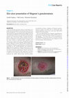 Research paper thumbnail of Skin ulcer presentation of Wegener's granulomatosis