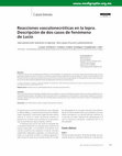 Research paper thumbnail of Reacciones vasculonecróticas en la lepra. Descripción de dos casos de fenómeno de Lucio