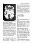 Research paper thumbnail of Cutaneous malignant melanoma metastatic to the choroid: A clinicopathological case report