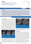 Research paper thumbnail of Sonographic Rim in Acute Renal Cortical Necrosis