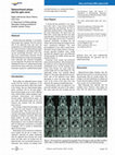 Research paper thumbnail of Sphenochoanal polyps and the optic nerve