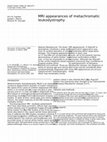 Research paper thumbnail of MRI appearances of metachromatic leukodystrophy