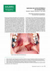 Research paper thumbnail of Sarcoma de Kaposi Epidémico en Cavidad Oral