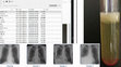 Research paper thumbnail of Drug Induced-Exudative Chylothorax Pleural Effusion in a Patient with Chronic Myeloid Leukemia being treated with Dasatinib