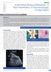 Research paper thumbnail of Endometrial Osseous Metaplasia—A Rare Presentation of Polymenorrhagia: A Case Report