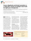 Research paper thumbnail of Severe oligodontia and dental anomalies in a child with a history of multiple natal teeth: An eight-year retrospective