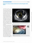 Research paper thumbnail of Underwater endoscopic submucosal dissection of an obstructing giant colonic lipoma