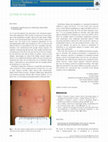 Research paper thumbnail of Association of pneumothorax with use of a bougie for endotracheal intubation in a neonate