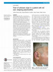 Research paper thumbnail of Fever of unknown origin in a patient with red ears: relapsing polychondritis