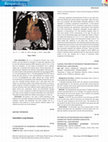 Research paper thumbnail of Pattern of Autoantibodies Involvement in Connective Tissue Disorder Associated Interstitial Lung Diseases