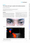 Research paper thumbnail of The hockey-stick sign in a patient with unilateral proptosis