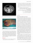 Research paper thumbnail of Giant mucinous borderline ovarian tumour