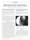 Research paper thumbnail of Right coronary artery arising as a terminal extension of the left circumflex artery (a rare coronary artery anomaly)