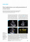 Research paper thumbnail of Heart palpitations as an early presentation of a heart tumor