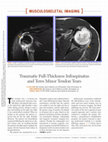 Research paper thumbnail of Traumatic Full-Thickness Infraspinatus and Teres Minor Tendon Tears