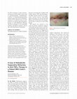 Research paper thumbnail of A Case of Hidradenitis Suppurativa Refractory to Anti-TNFα Therapy in a Patient With Crohn's Disease