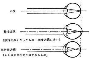 近視