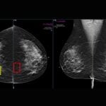 Ai Enhanced Mammogram