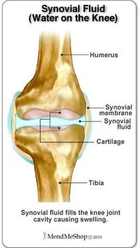 disease. Osteoarthritis in the knee is the most common type, and there are a number of causes that influence your risk of developing it. These can be broken down into 2 types: primary osteoarthritis and secondary osteoarthritis.