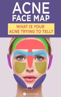 Acne Face Map: What Is Your Acne Trying To Tell You? Acne on your face is more than just clogged pores, hormones, and bacteria. The location of the breakout indicates a lot about your overall health and how certain lifestyle factors are affecting you. Keep reading to find out. #Skincare #BeautyTips #Acne #Pimples