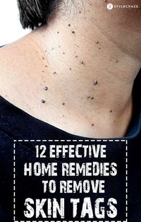 12 Effective Home Remedies To Remove Skin Tags: There is no need to go for fancy chemical or cosmetic procedures to remove these outgrowths. You can use simple ingredients found at home and get rid of them easily, and at a very low cost. #remedies #homeremedies #skin #skincare