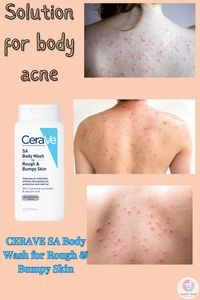 CeraVe SA Body Wash for Rough and Bumpy Skin gently exfoliates and smooths skin texture, helping to clear body acne with salicylic acid and hydrating ceramides. #bodyacne #bodycare #bodycareroutine #bodycareathome #howtocurebodyacne #bodyacnetreatments #bodywash #cerave #ceraveskincare