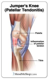 The knee has 2 collateral (parallel) ligaments and 2 cruciate (crossing) ligaments. The medial collateral ligament (MCL) and the lateral collateral ligament (LCL) provide support to the knee by limiting the sideways motion of the joint. The anterior cruciate ligament (ACL) and the posterior cruciate ligament (PCL) stabilize the knee by limiting the rotation and the forward and backward movement of the joint.