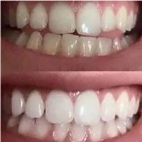 Snow Teeth Whitening Kit