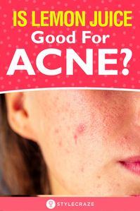 Is Lemon Juice Good For Acne And Acne Scars? Herbal medicine believes that lemons have beneficial properties that can help with skin issues like acne and scarring. But, are lemons really effective in treating acne? Let’s find out!