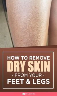 How To Remove Dry Skin From Your Feet And Legs: Is the dry, flaky skin on your feet and legs irritating you? Then, come aboard and resolve this skin issue with the remedies in this article. #Beauty #BeautyTips #DrySkin