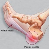 Natural Cures For Plantar Fasciitis