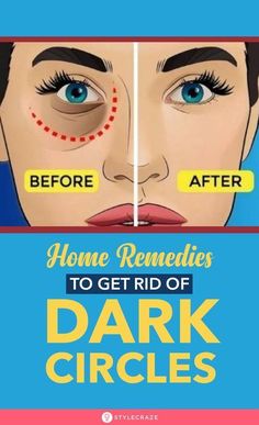 13 Natural Ways To Treat Dark Circles Under The Eyes At Home