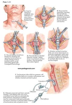 the diagram shows different types of medical devices and their functions, including an external ventilator