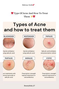 Struggling with acne? You're not alone! Discover the different types of acne and learn effective treatments to get clear, glowing skin. 🌟 From blackheads to cystic acne, we've got you covered with expert tips and recommended products. 🌿✨  types of acne, acne treatment, blackheads, whiteheads, papules, pustules, nodules, cystic acne, acne solutions, skincare routine, acne prevention, salicylic acid, benzoyl peroxide, topical retinoids, alpha hydroxy acids, acne medication, dermatologist tips, clear skin, acne care, skincare products"   #AcneTypes #AcneTreatment #ClearSkin #Blackheads #Whiteheads #Papules #Pustules #Nodules #CysticAcne #SkincareRoutine #AcneSolutions #BenzoylPeroxide #SalicylicAcid #TopicalRetinoids #AlphaHydroxyAcids #AcnePrevention #SkincareTips #AcneCare #dermalpiercing Clyndamiacin For Acne, What Does My Acne Mean, How To Get Rid Of Nodules Acne, Homemade Foot Mask, Fungle Acne, Acne Guide, Ingredients For Oily Skin, Papules Acne, Remove Whiteheads