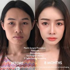 For more information: ❤️Whatsapp: +82-10-2103-7174 💛Kakao: viewinquiry 💚LINE: viewinquiry ✉️E-mail: eng_viewps@viewclinic.com 💎Website: www.viewplasticsurgery.com Kpop Plastic Surgery, Jaw Reduction Surgery, Face Symmetry, V Line Surgery, Plastic Surgery Fail, Korean Plastic Surgery, Plastic Surgery Gone Wrong, Face Surgery