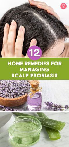 12 Home Remedies For Managing Scalp Psoriasis: It is often mistakenly thought that psoriasis only affects the skin on your arms, legs, or back. On the contrary, psoriasis can appear on any part of the body, including the scalp. And, like other common skin conditions, home remedies for scalp psoriasis can be effective in helping you treat the problem if you know how to apply them correctly. Skin Remedies, Home Remedies, Hair Hair